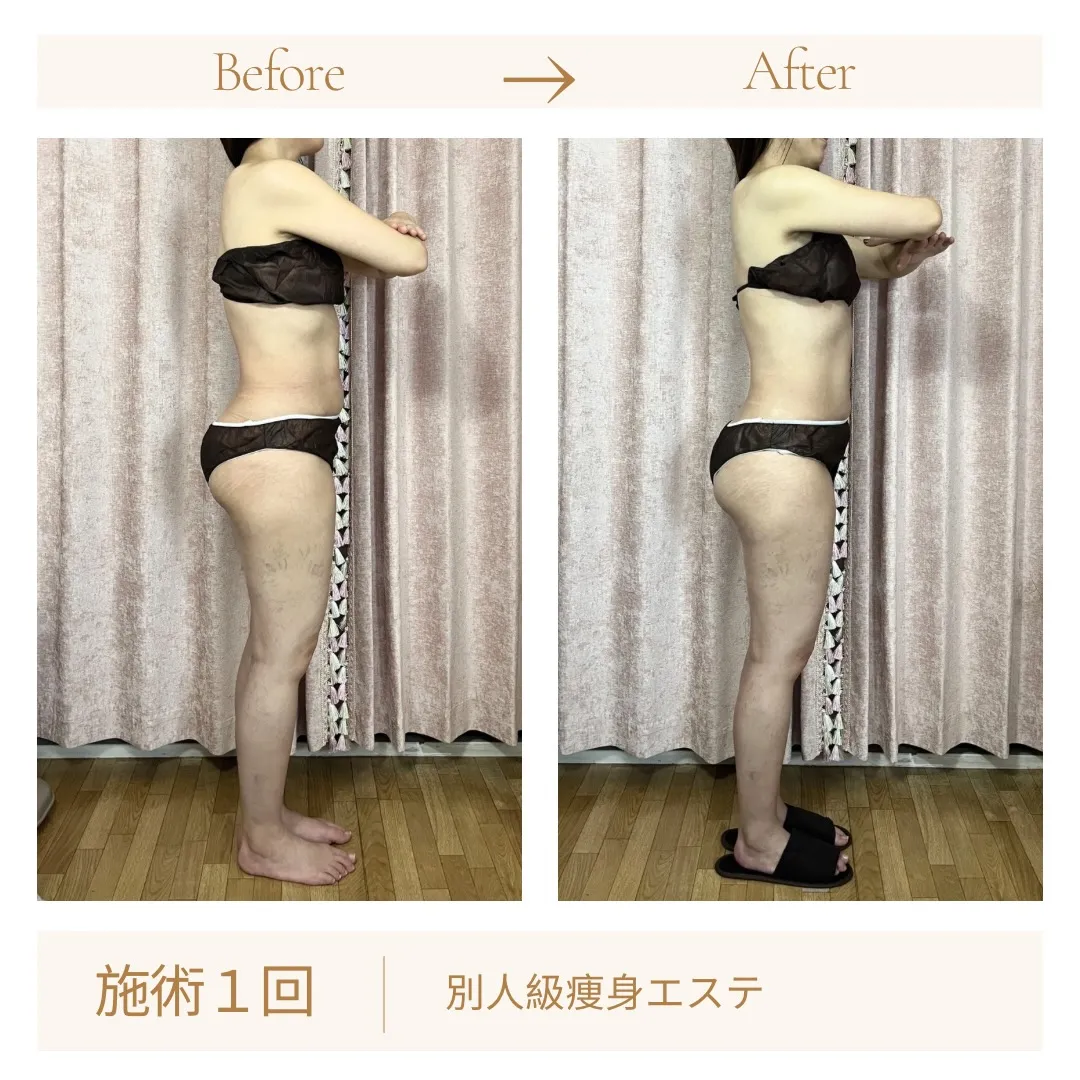 施術1回で、この変化。